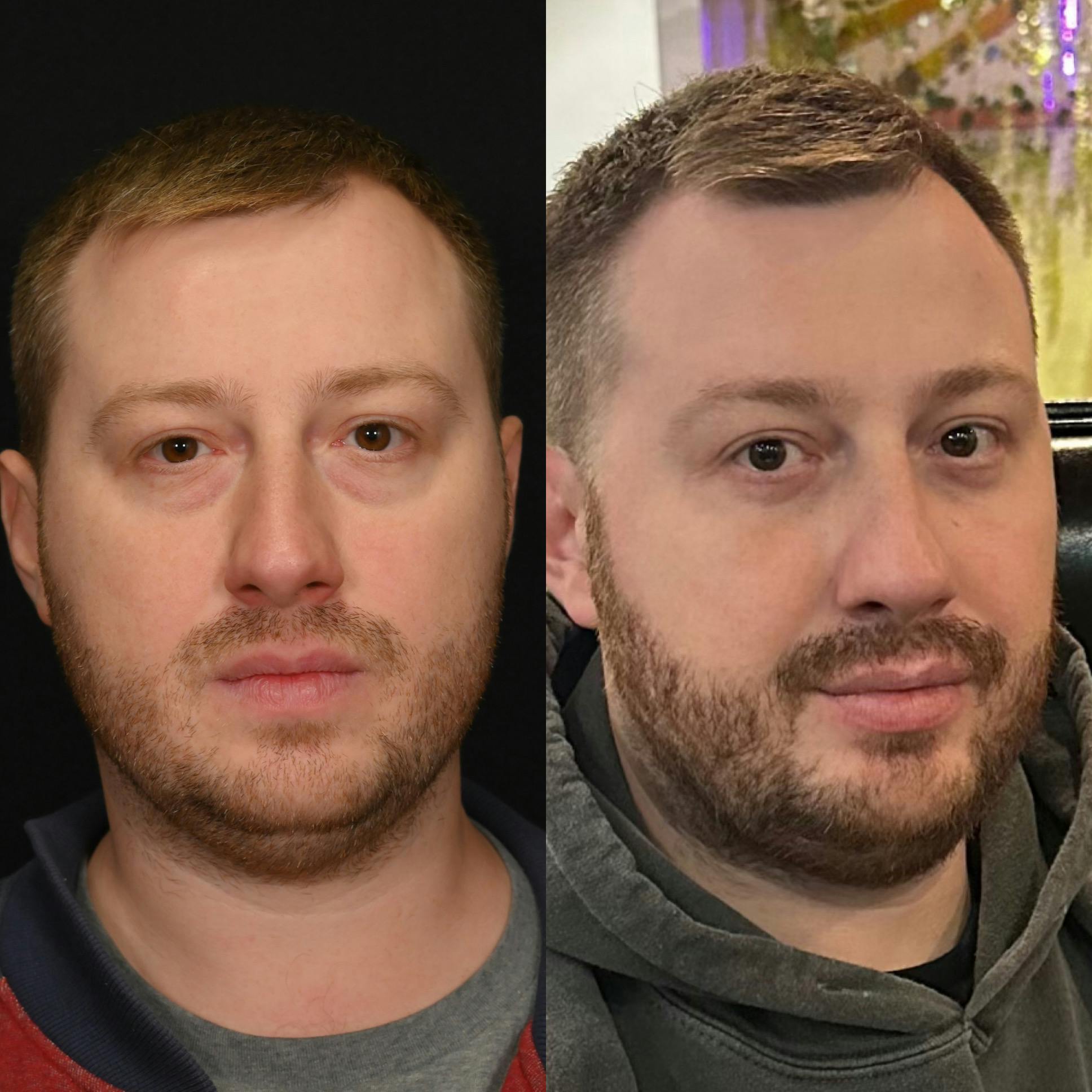 Lower Blepharoplasty Before & After Gallery - Patient 292509 - Image 2