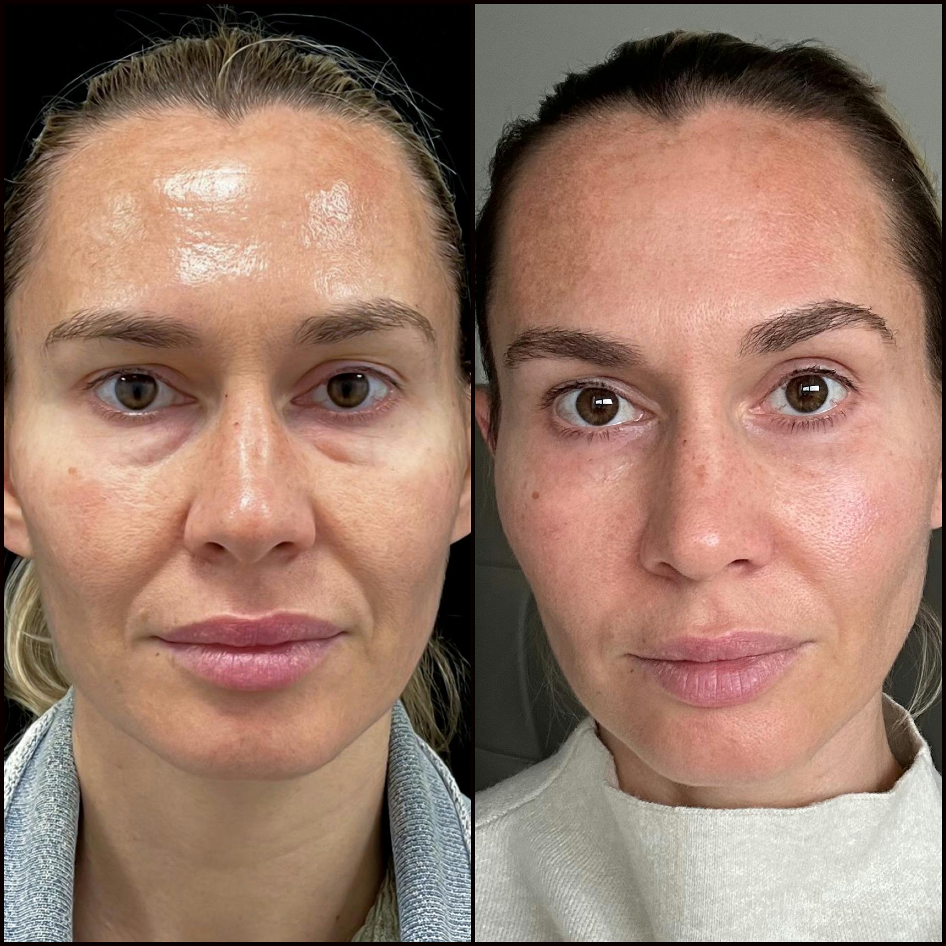 Lower Blepharoplasty Before & After Gallery - Patient 916114 - Image 1