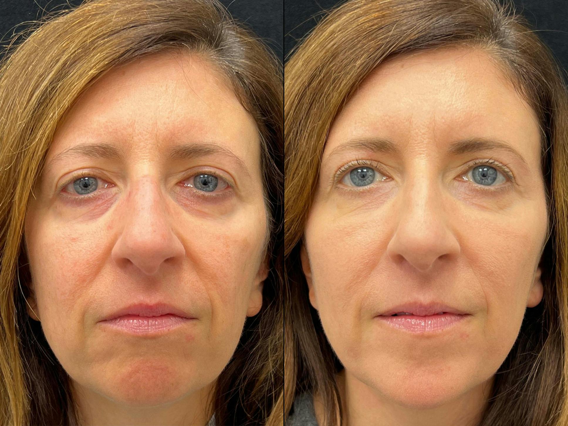 Dermal Fillers Before & After Gallery - Patient 645274 - Image 1