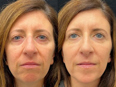 Dermal Fillers Before & After Gallery - Patient 645274 - Image 1