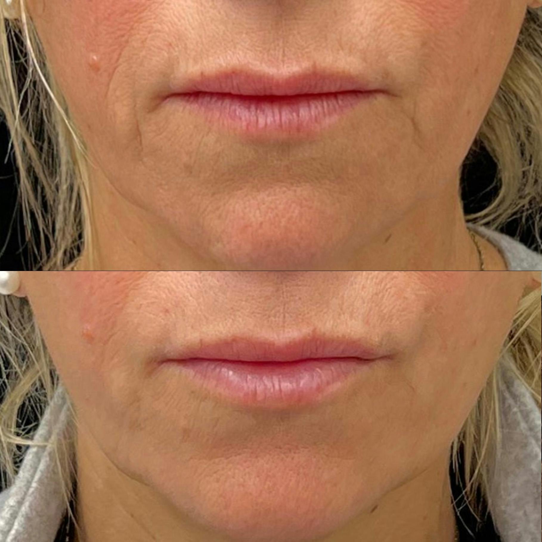 Dermal Fillers Before & After Gallery - Patient 450683 - Image 1