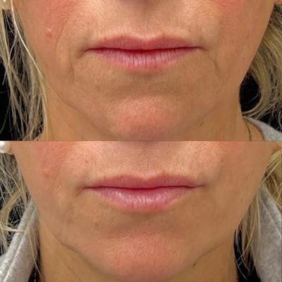 Dermal Fillers Before & After Gallery - Patient 450683 - Image 1