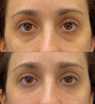 Eyelid Filler Before & After Gallery - Patient 204604 - Image 1