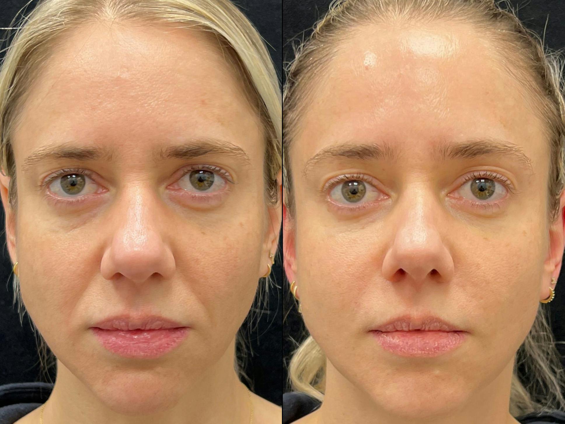 Dermal Fillers Before & After Gallery - Patient 281888 - Image 1