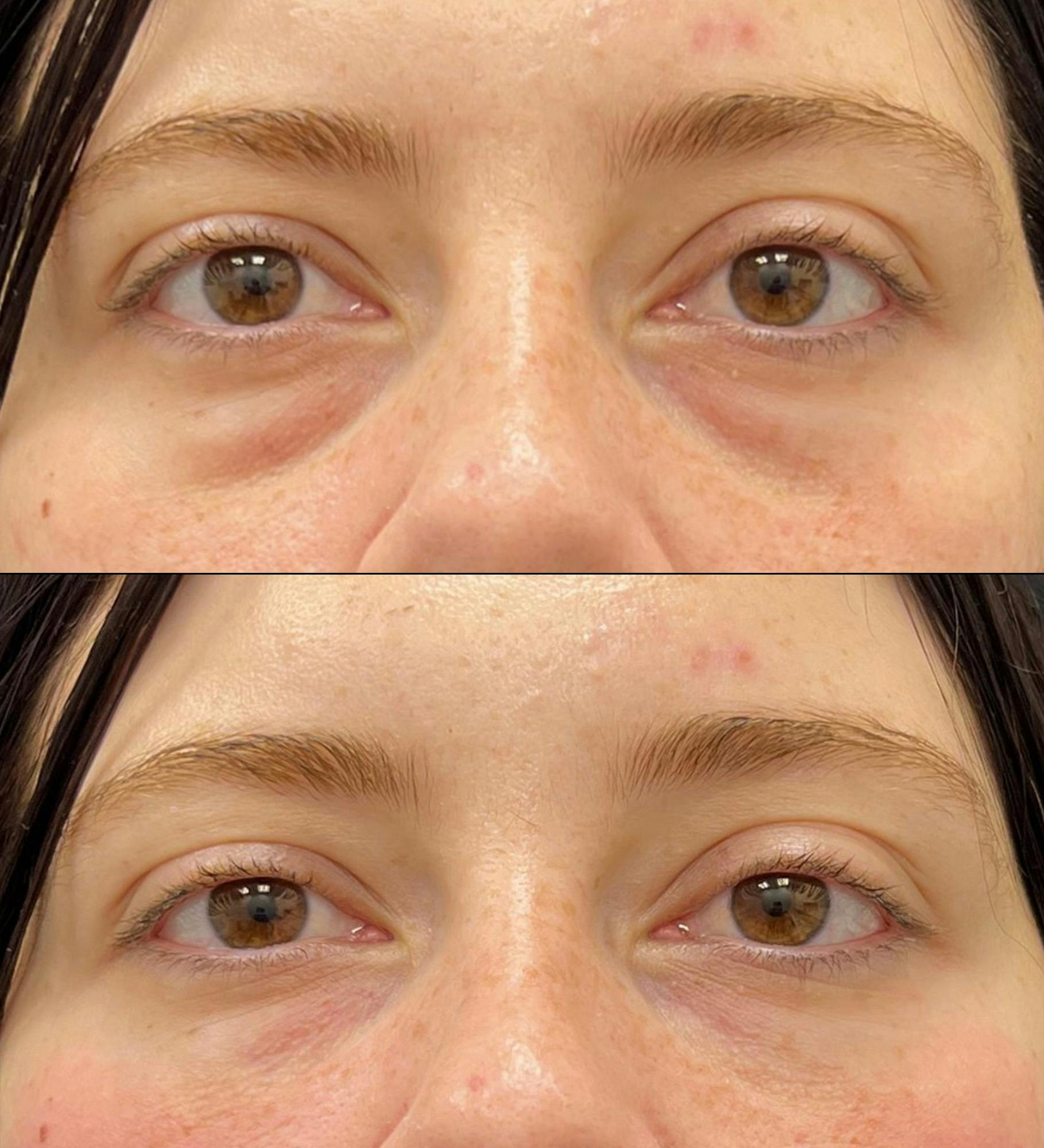 Eyelid Filler Before & After Gallery - Patient 173462 - Image 1