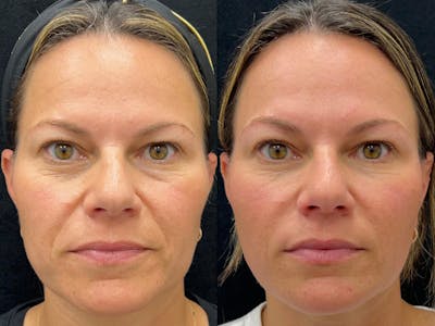 Dermal Fillers Before & After Gallery - Patient 405413 - Image 1