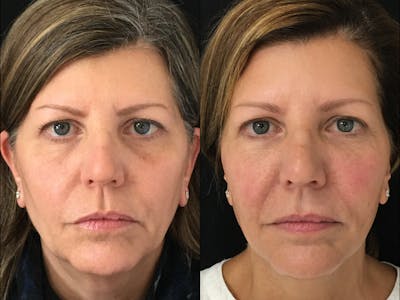 Dermal Fillers Before & After Gallery - Patient 56572312 - Image 1
