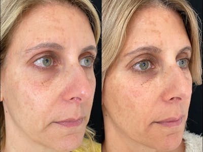 Dermal Fillers Before & After Gallery - Patient 53591926 - Image 1