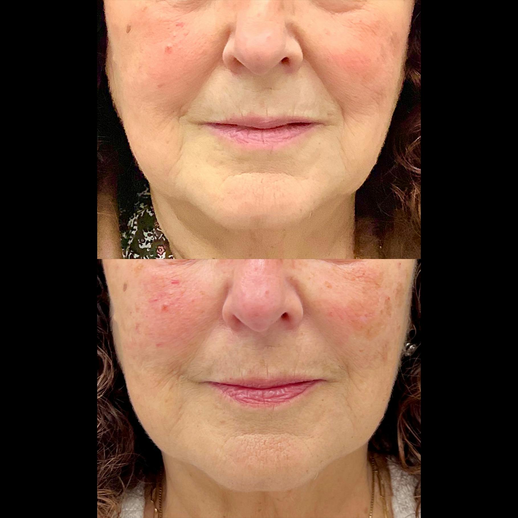 Dermal Fillers Before & After Gallery - Patient 281075 - Image 1