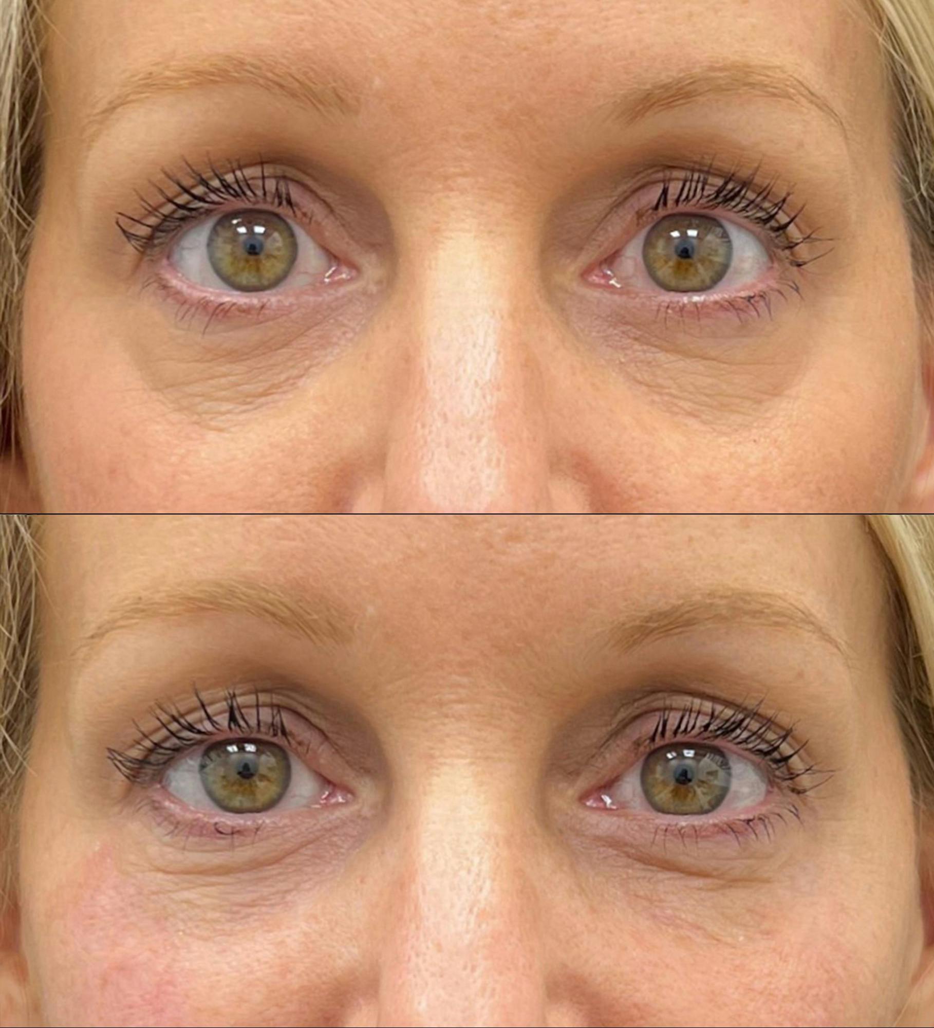 Eyelid Filler Before & After Gallery - Patient 287896 - Image 1