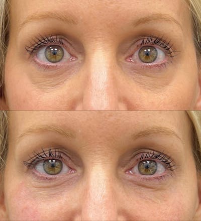 Eyelid Filler Before & After Gallery - Patient 287896 - Image 1