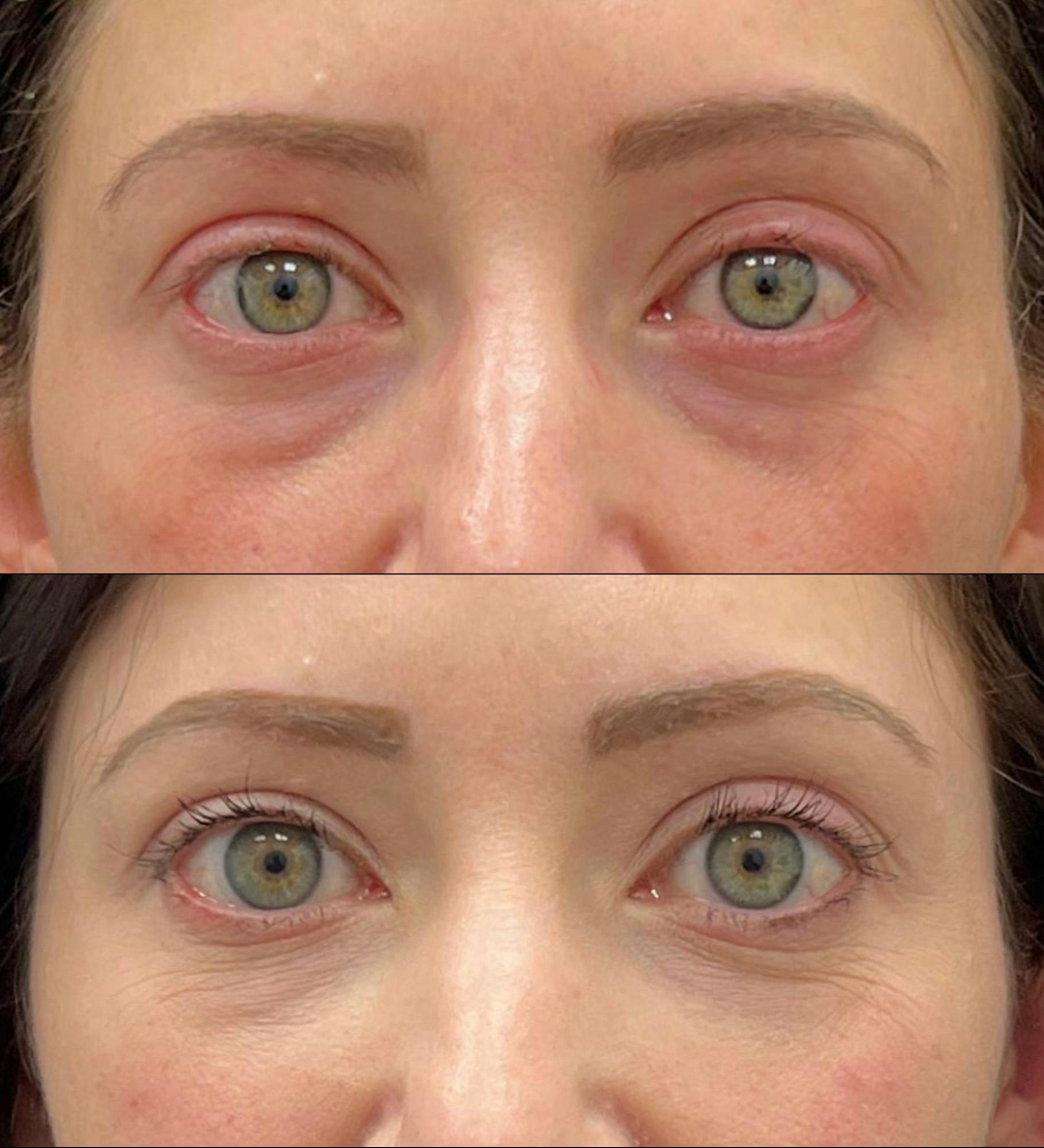 Eyelid Filler Before & After Gallery - Patient 477026 - Image 1