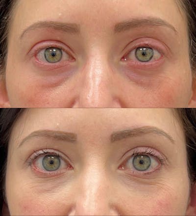 Eyelid Filler Before & After Gallery - Patient 477026 - Image 1