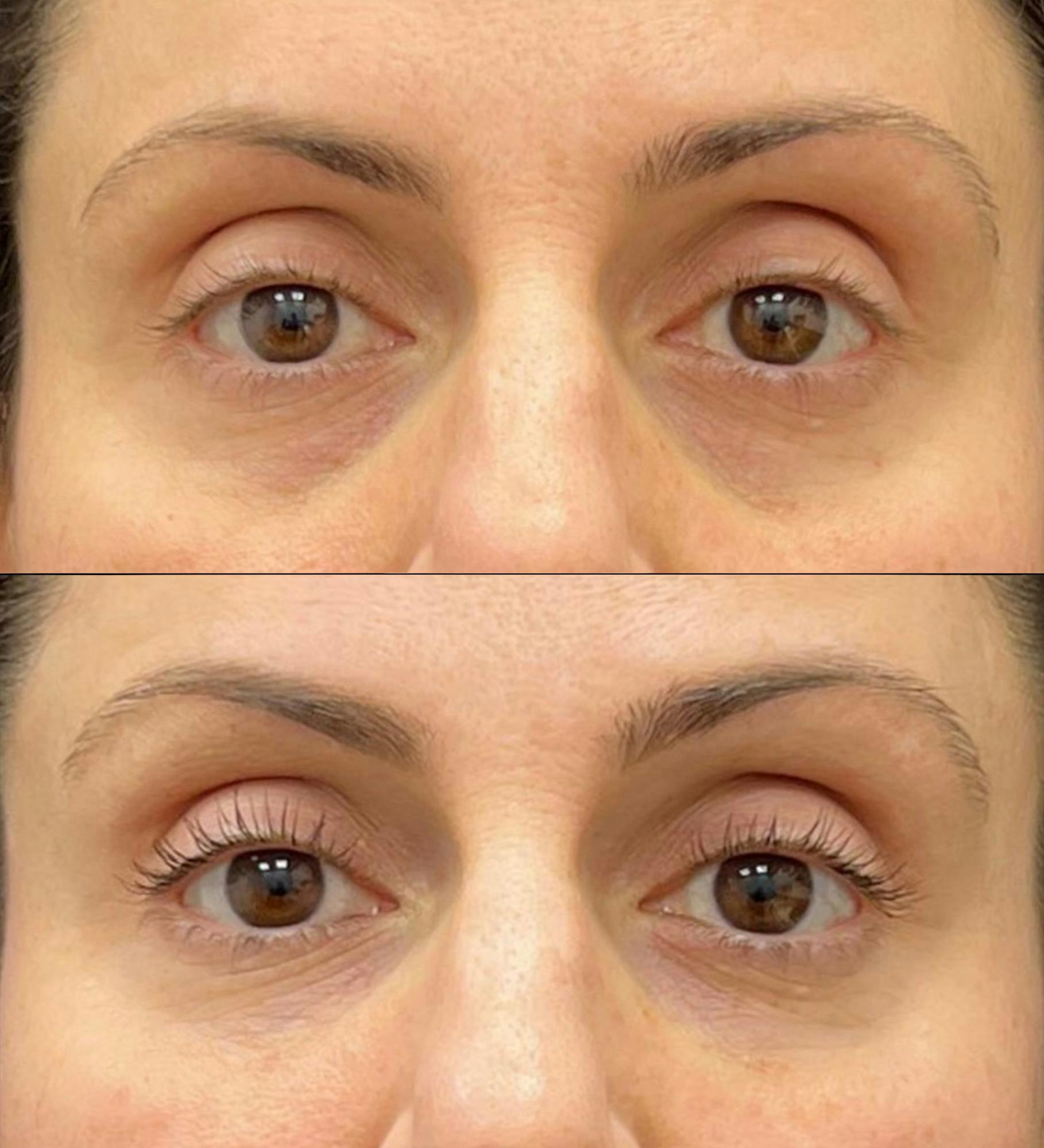 Eyelid Filler Before & After Gallery - Patient 422525 - Image 1
