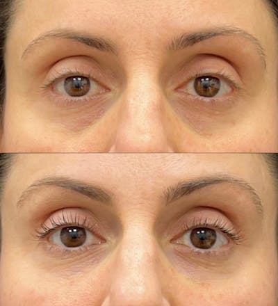 Eyelid Filler Before & After Gallery - Patient 422525 - Image 1
