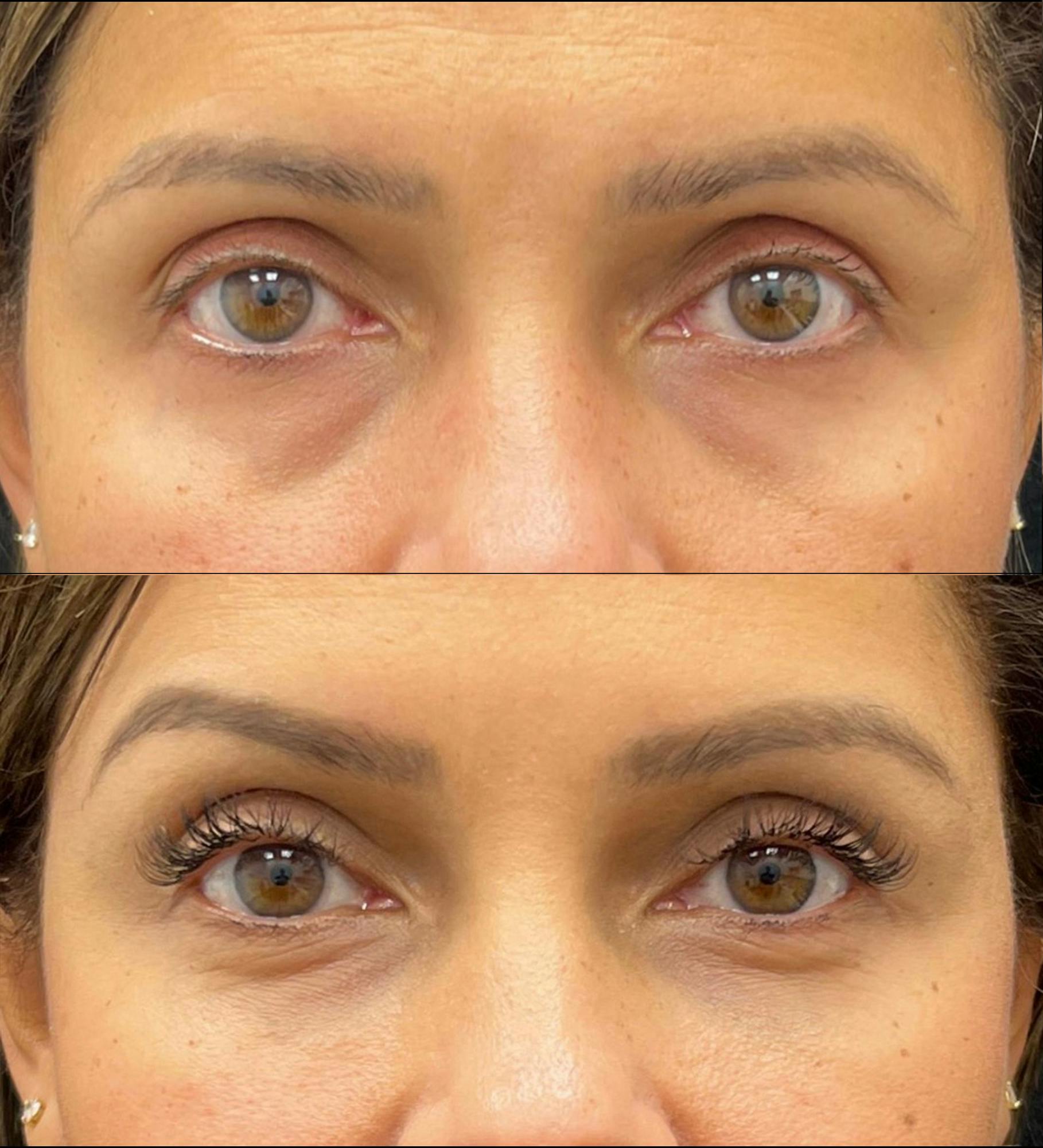 Eyelid Filler Before & After Gallery - Patient 187610 - Image 1
