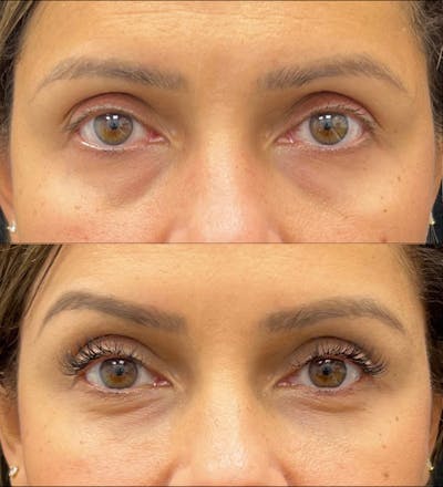 Eyelid Filler Before & After Gallery - Patient 187610 - Image 1