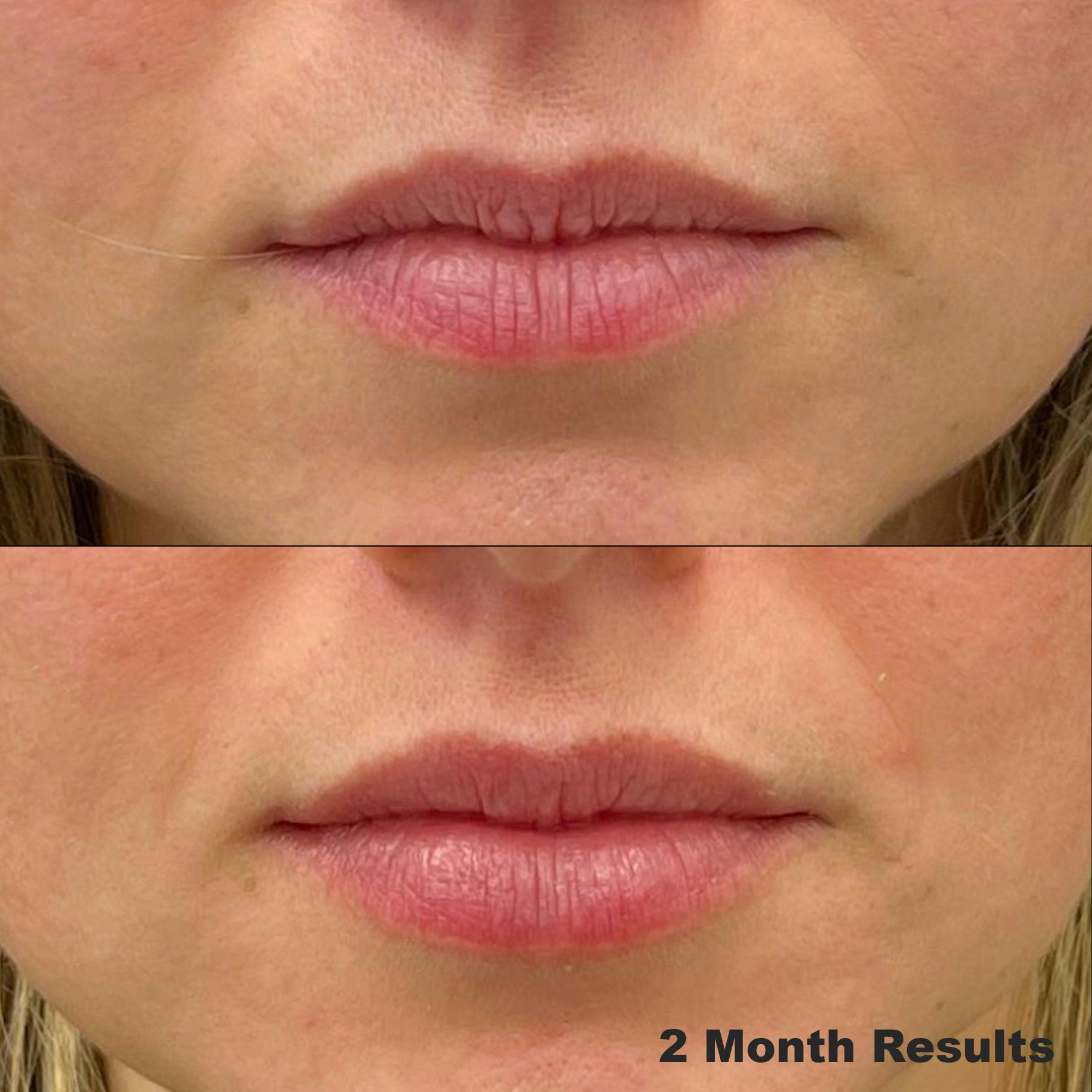 Lip Enhancement Before & After Gallery - Patient 264028 - Image 1