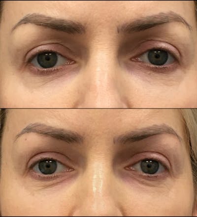 Eyelid Filler Before & After Gallery - Patient 274271 - Image 1