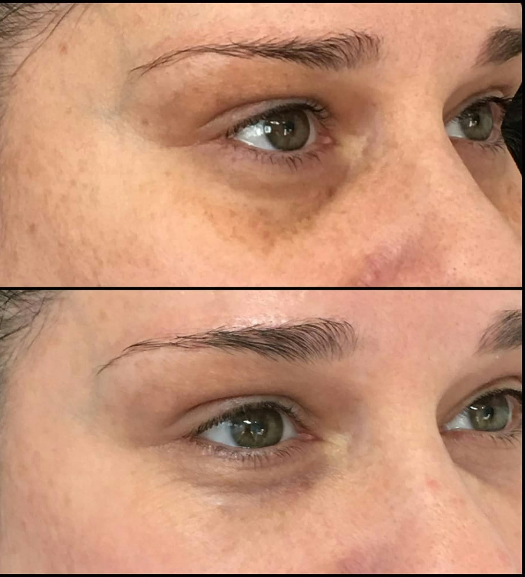 Eyelid Filler Before & After Gallery - Patient 54031164 - Image 1