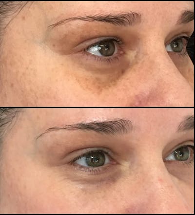 Eyelid Filler Before & After Gallery - Patient 54031164 - Image 1