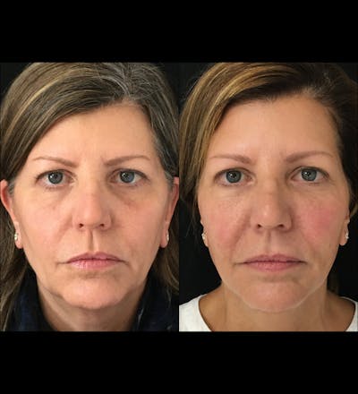 Eyelid Filler Before & After Gallery - Patient 56572310 - Image 1