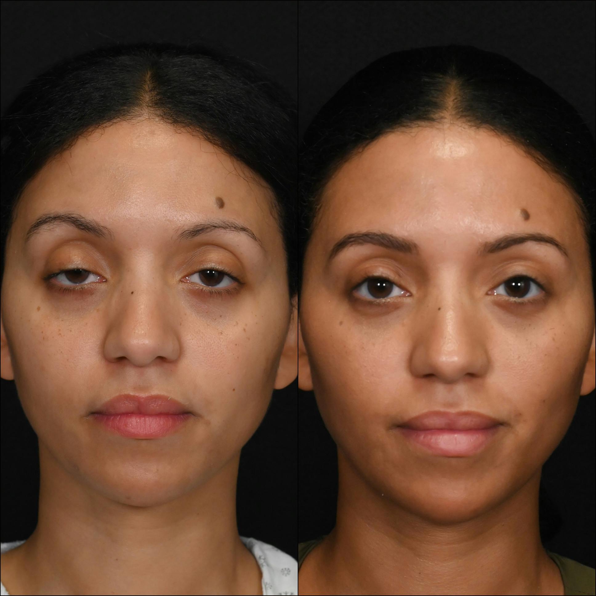 Ptosis Repair Before & After Gallery - Patient 424328 - Image 1