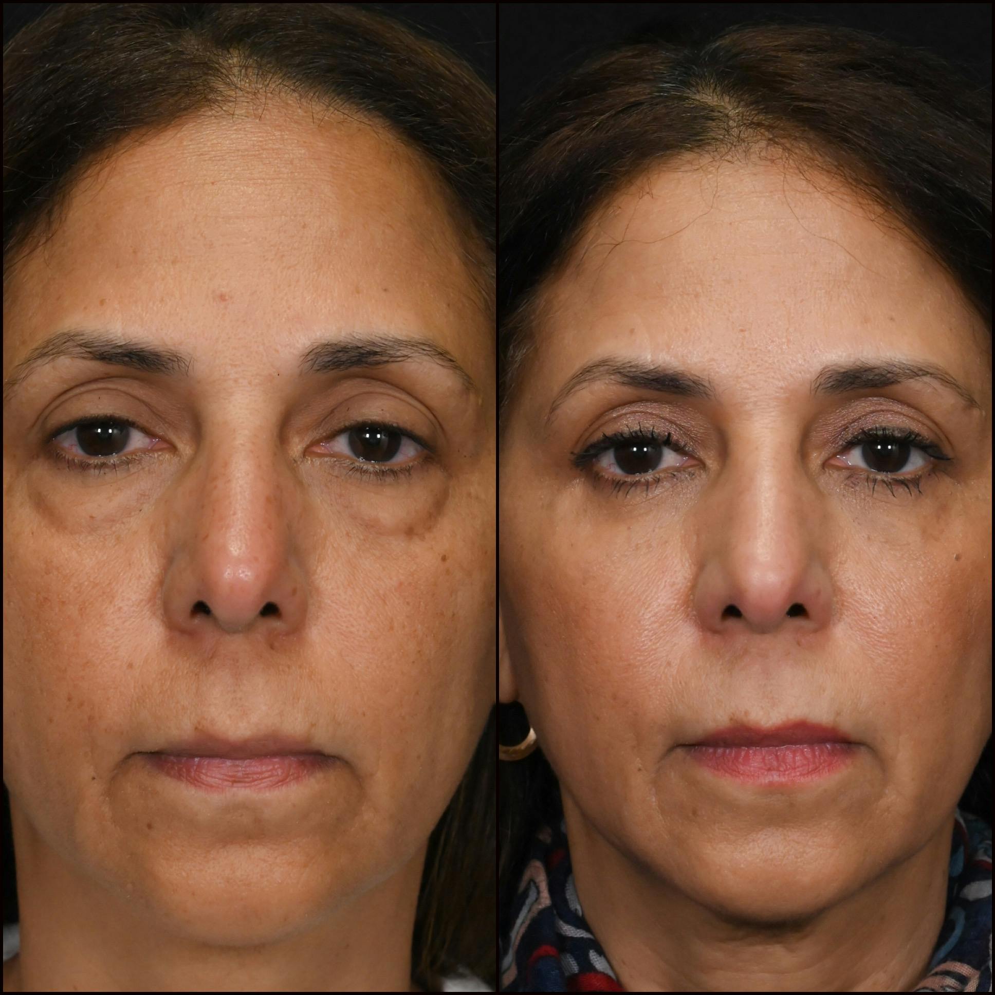Lower Blepharoplasty Before & After Gallery - Patient 410892 - Image 1