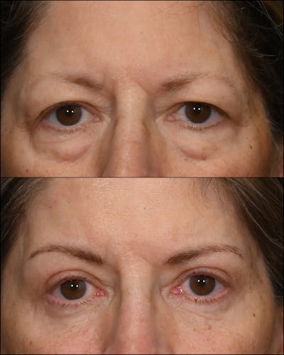 Upper & Lower Blepharoplasty Before & After Gallery - Patient 390938 - Image 1