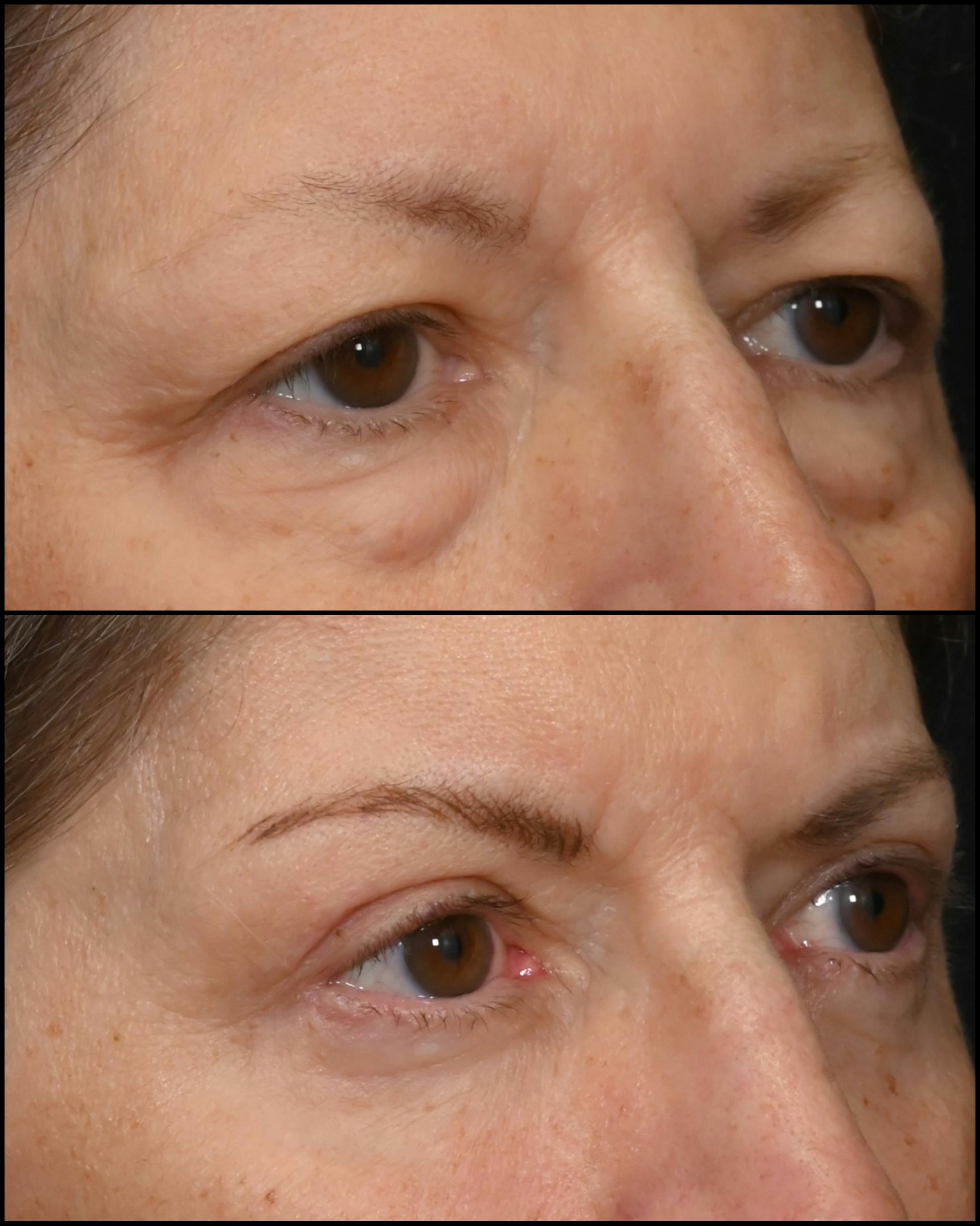 Upper & Lower Blepharoplasty Before & After Gallery - Patient 390938 - Image 2