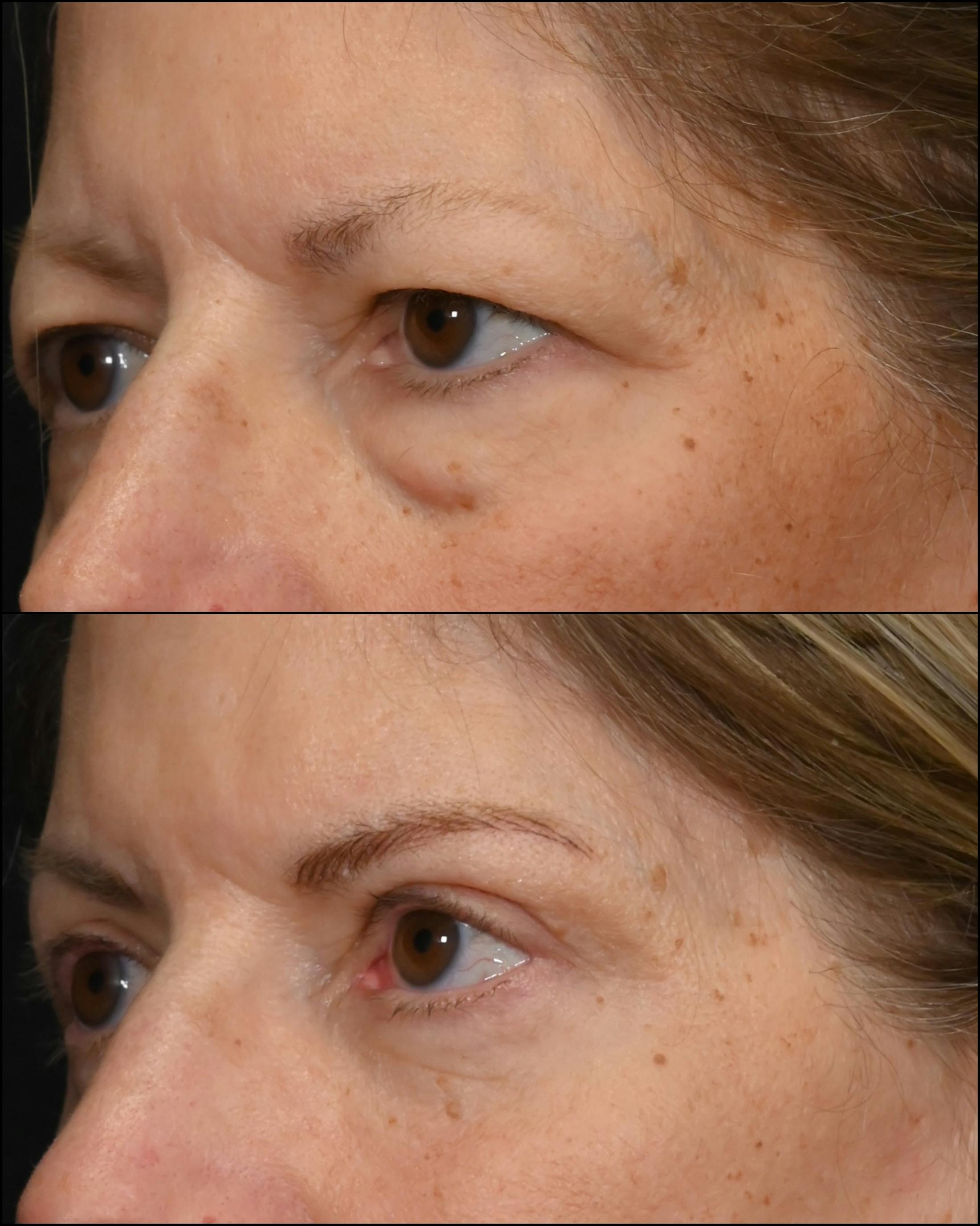 Upper & Lower Blepharoplasty Before & After Gallery - Patient 390938 - Image 3