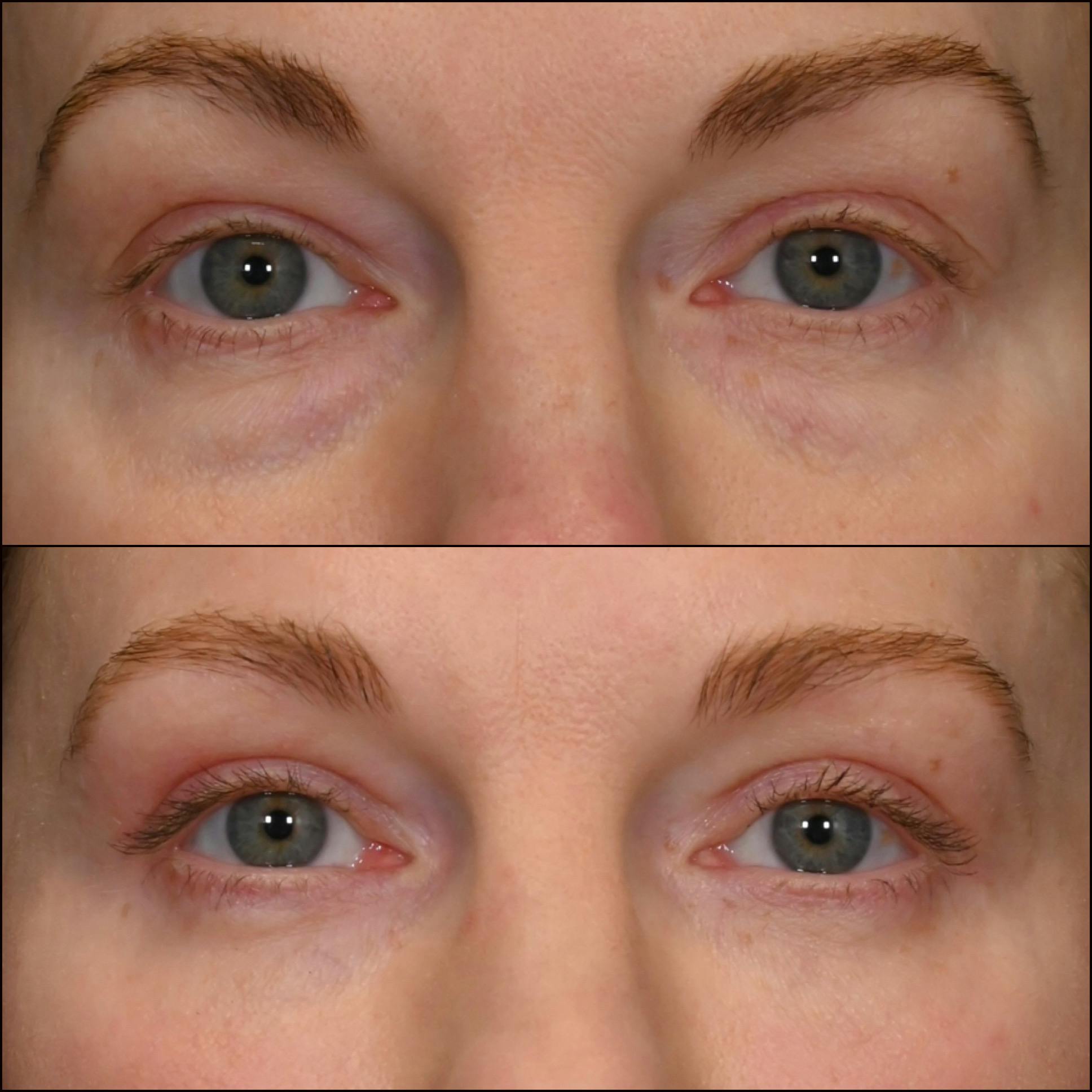 Upper & Lower Blepharoplasty Before & After Gallery - Patient 406891 - Image 1