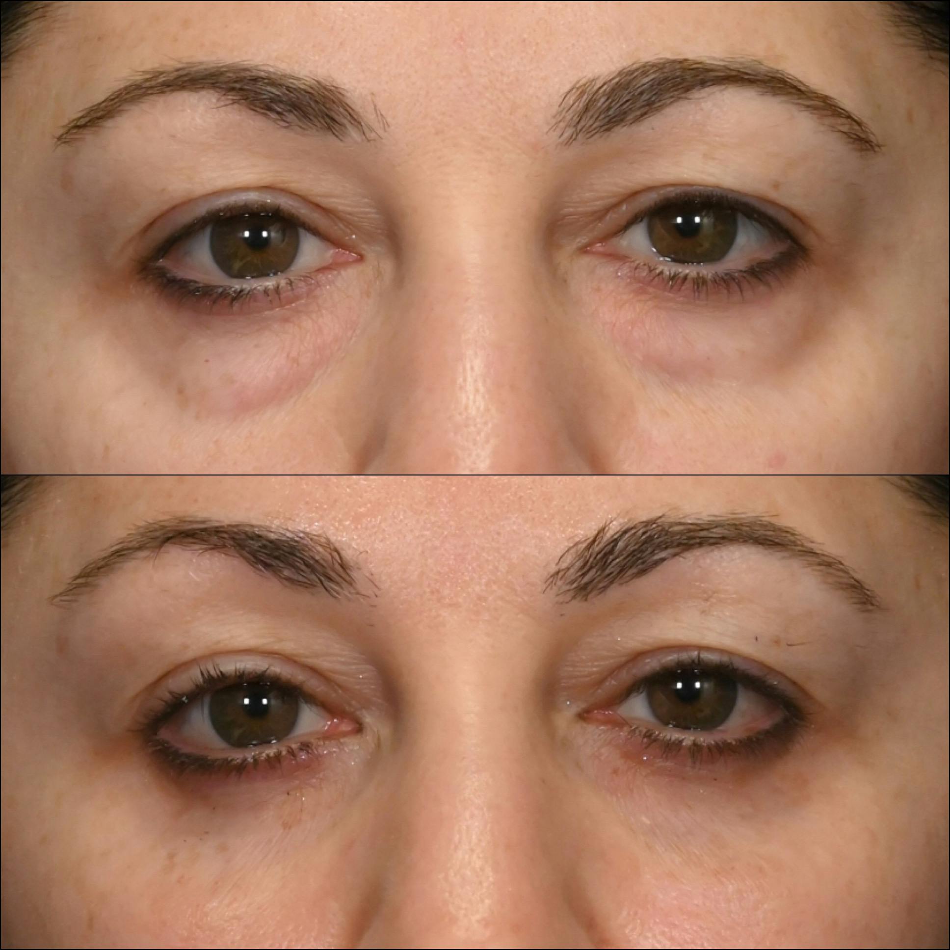 Lower Blepharoplasty Before & After Gallery - Patient 186309 - Image 1