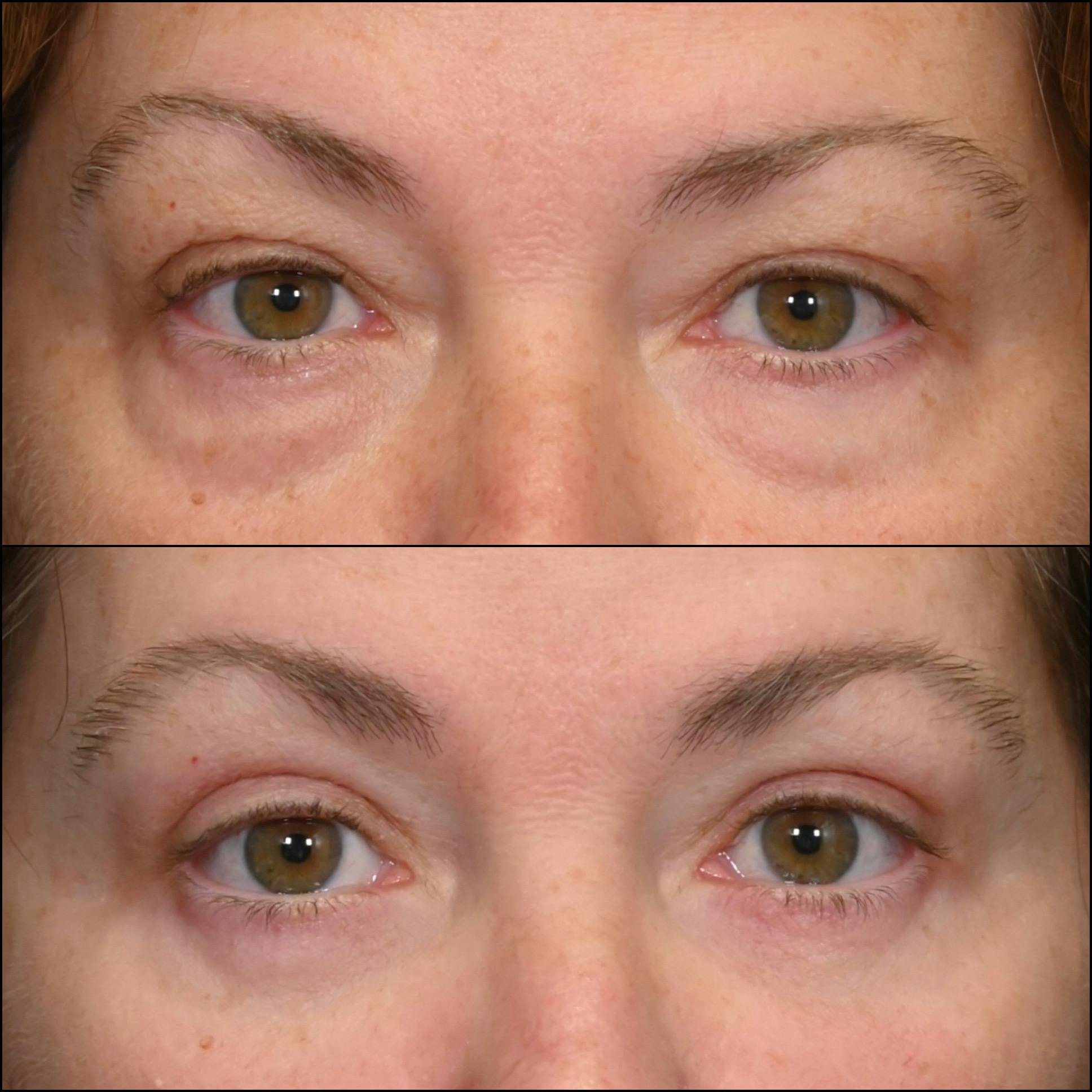 Upper & Lower Blepharoplasty Before & After Gallery - Patient 421873 - Image 1