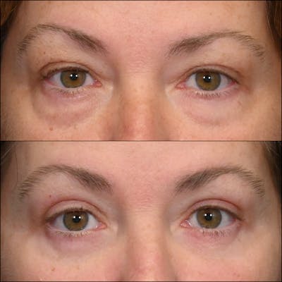 Upper Blepharoplasty Before & After Gallery - Patient 288363 - Image 1