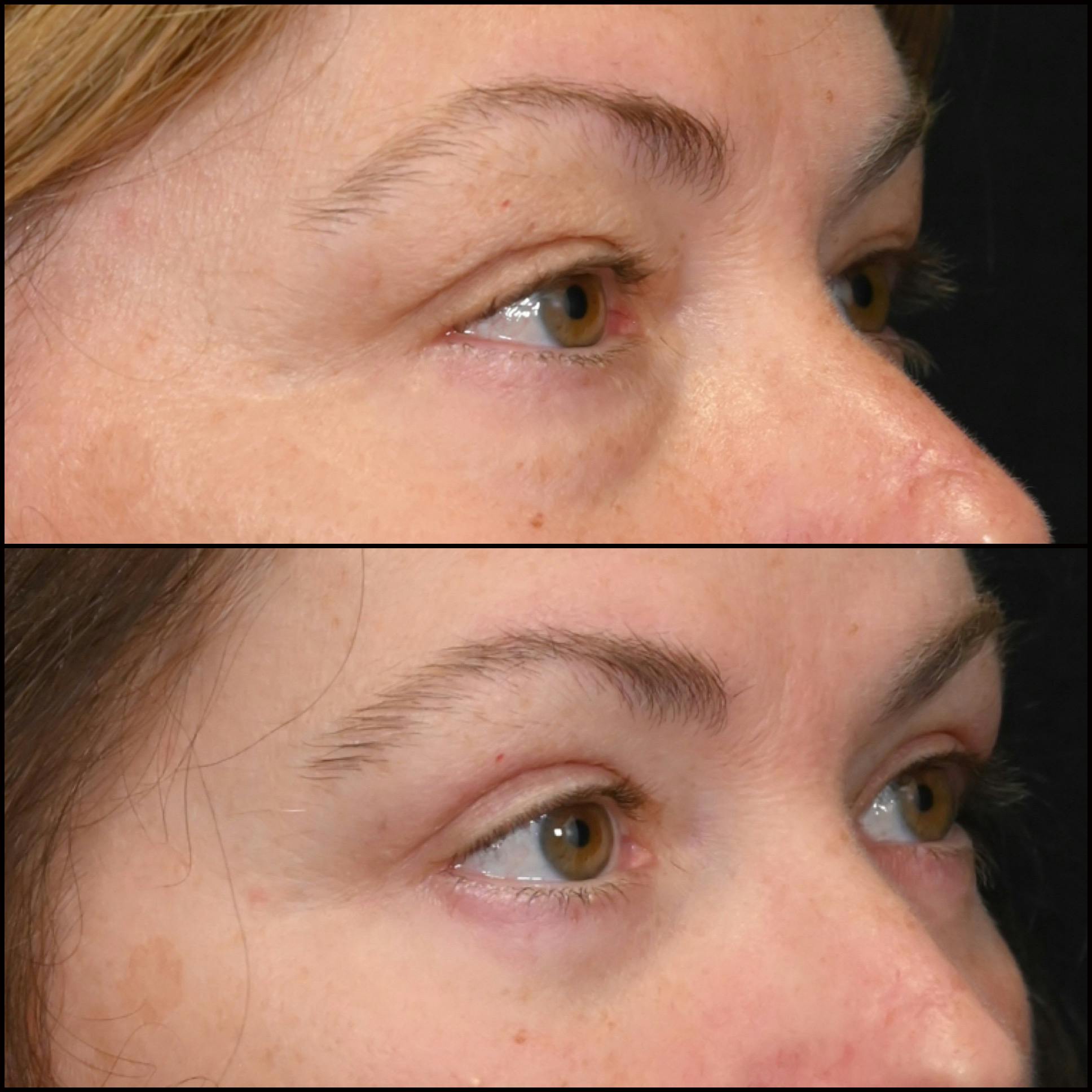 Upper & Lower Blepharoplasty Before & After Gallery - Patient 421873 - Image 2