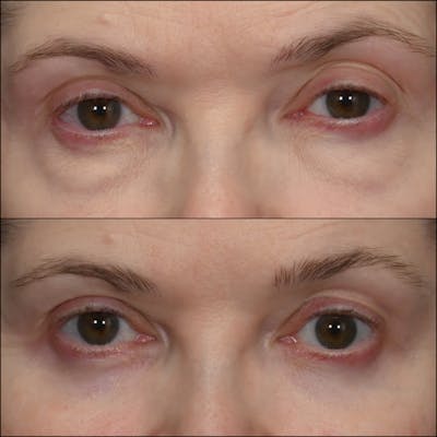 Lower Blepharoplasty Before & After Gallery - Patient 176238 - Image 1