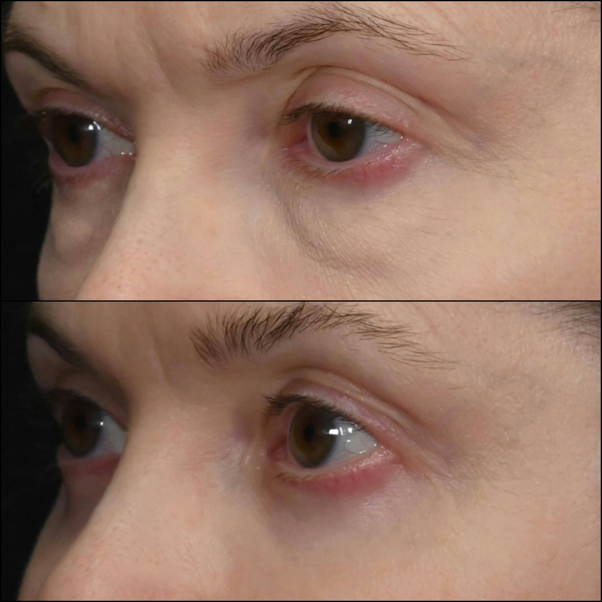 Lower Blepharoplasty Before & After Gallery - Patient 176238 - Image 3