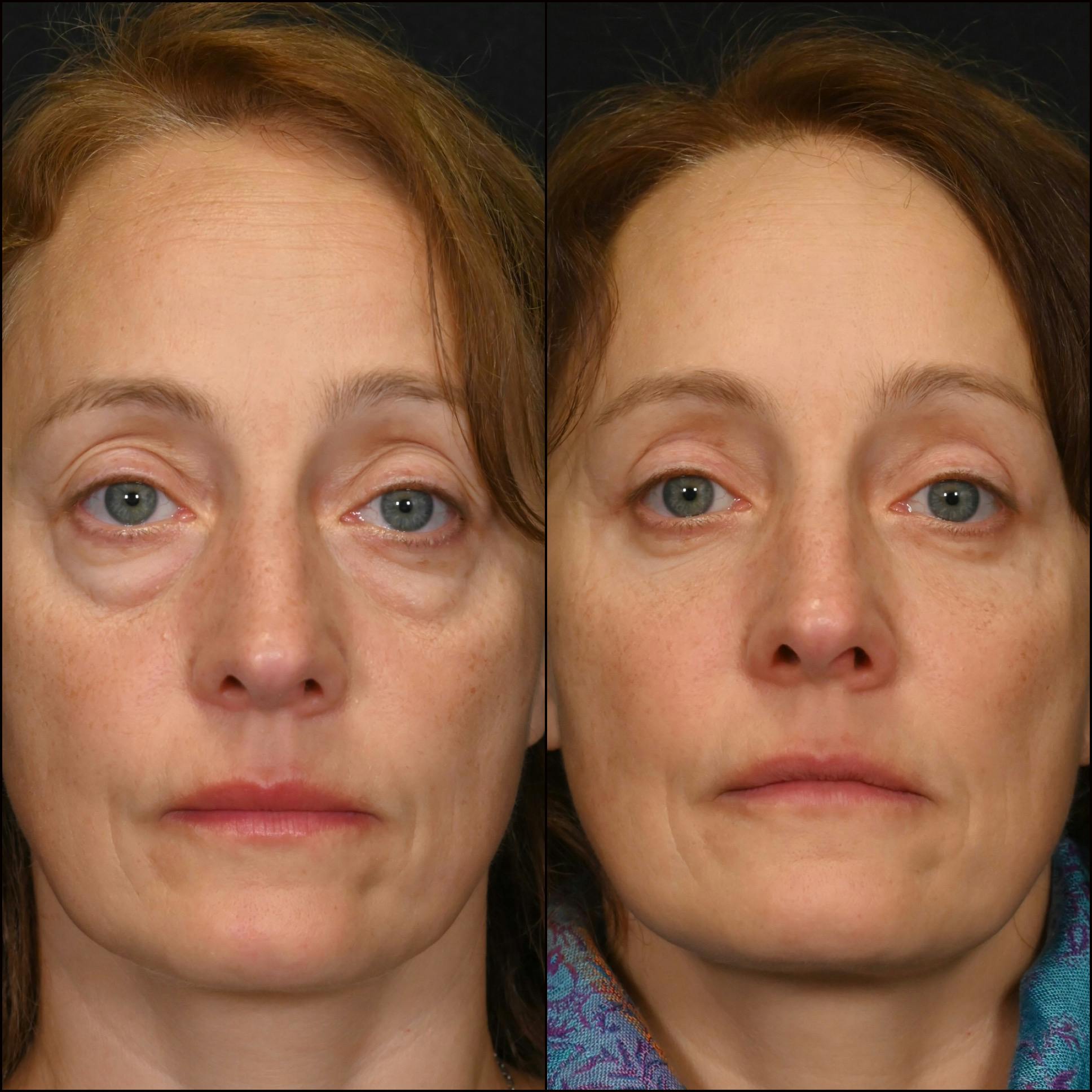 Upper Blepharoplasty Before & After Gallery - Patient 162434 - Image 1