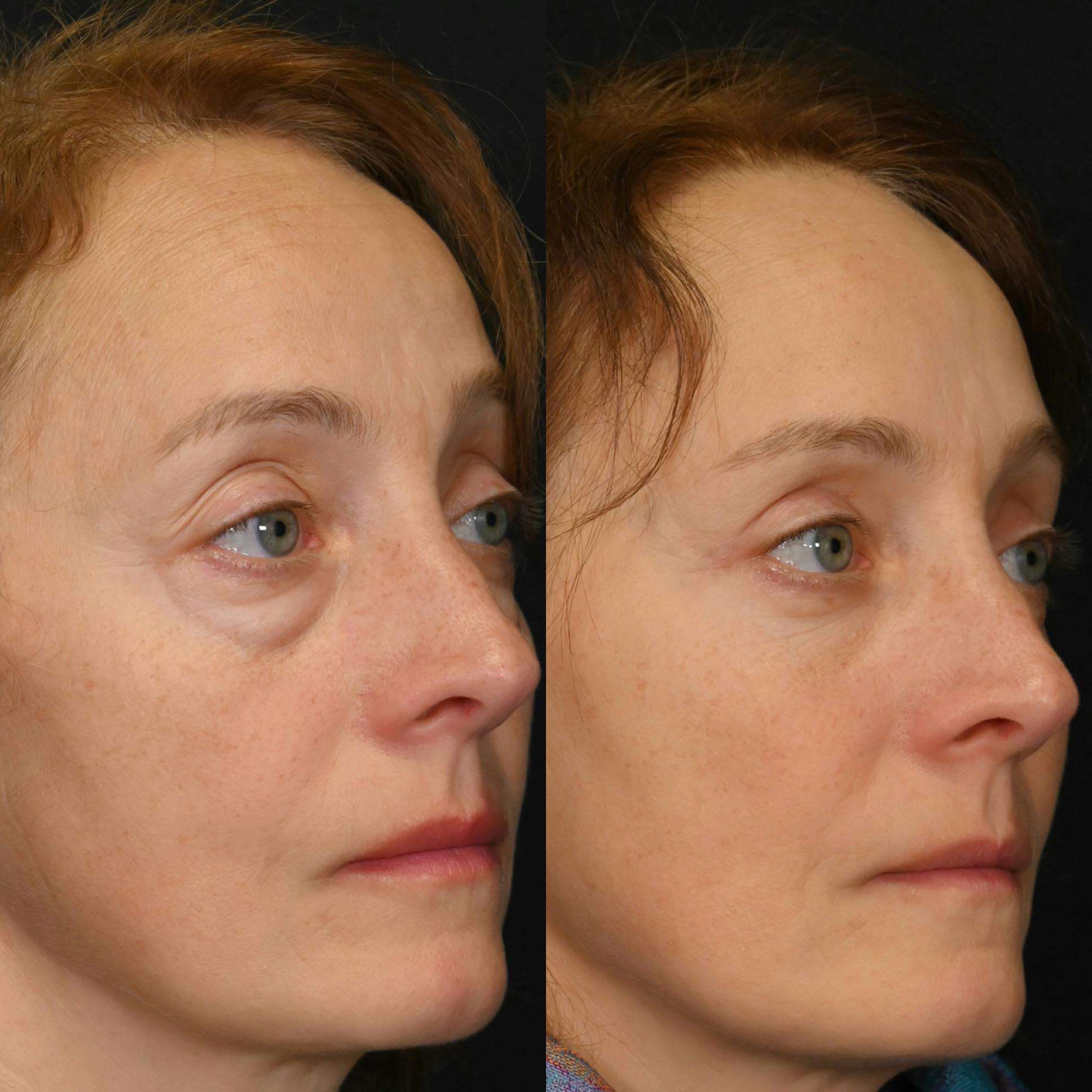 Upper Blepharoplasty Before & After Gallery - Patient 162434 - Image 3