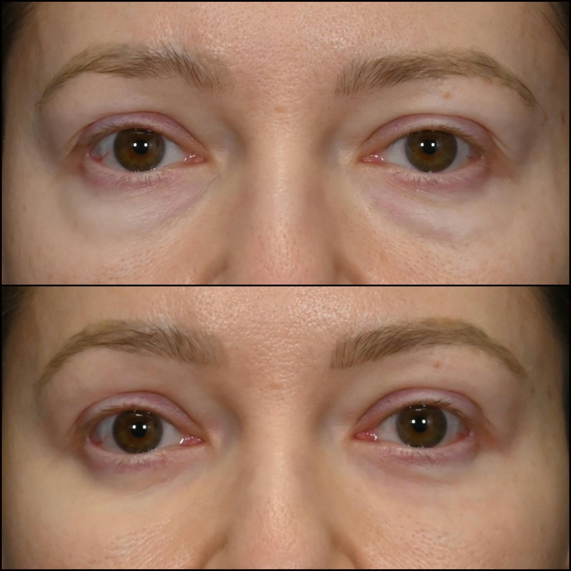 Lower Blepharoplasty Before & After Gallery - Patient 186771 - Image 1