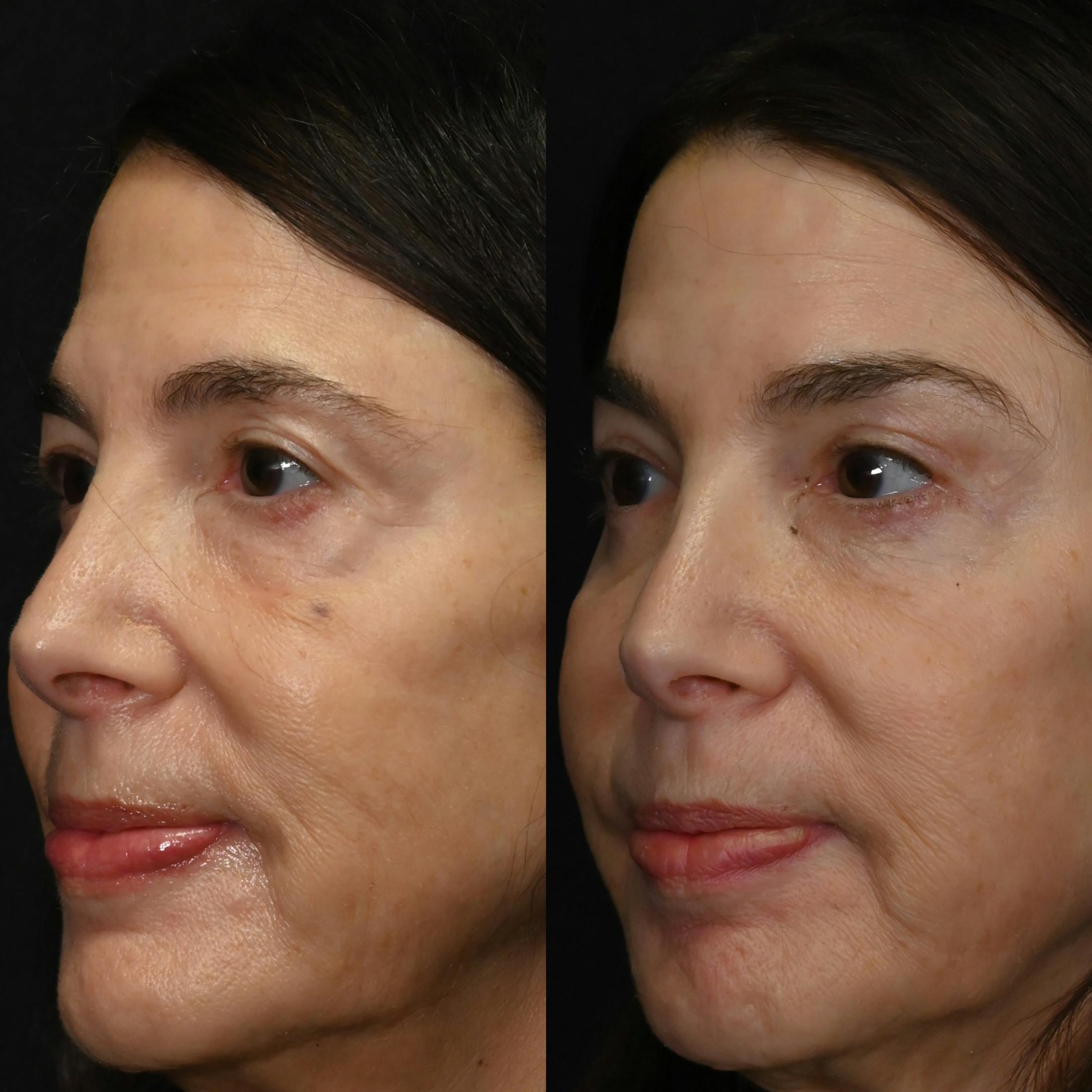 Upper & Lower Blepharoplasty Before & After Gallery - Patient 171889 - Image 3