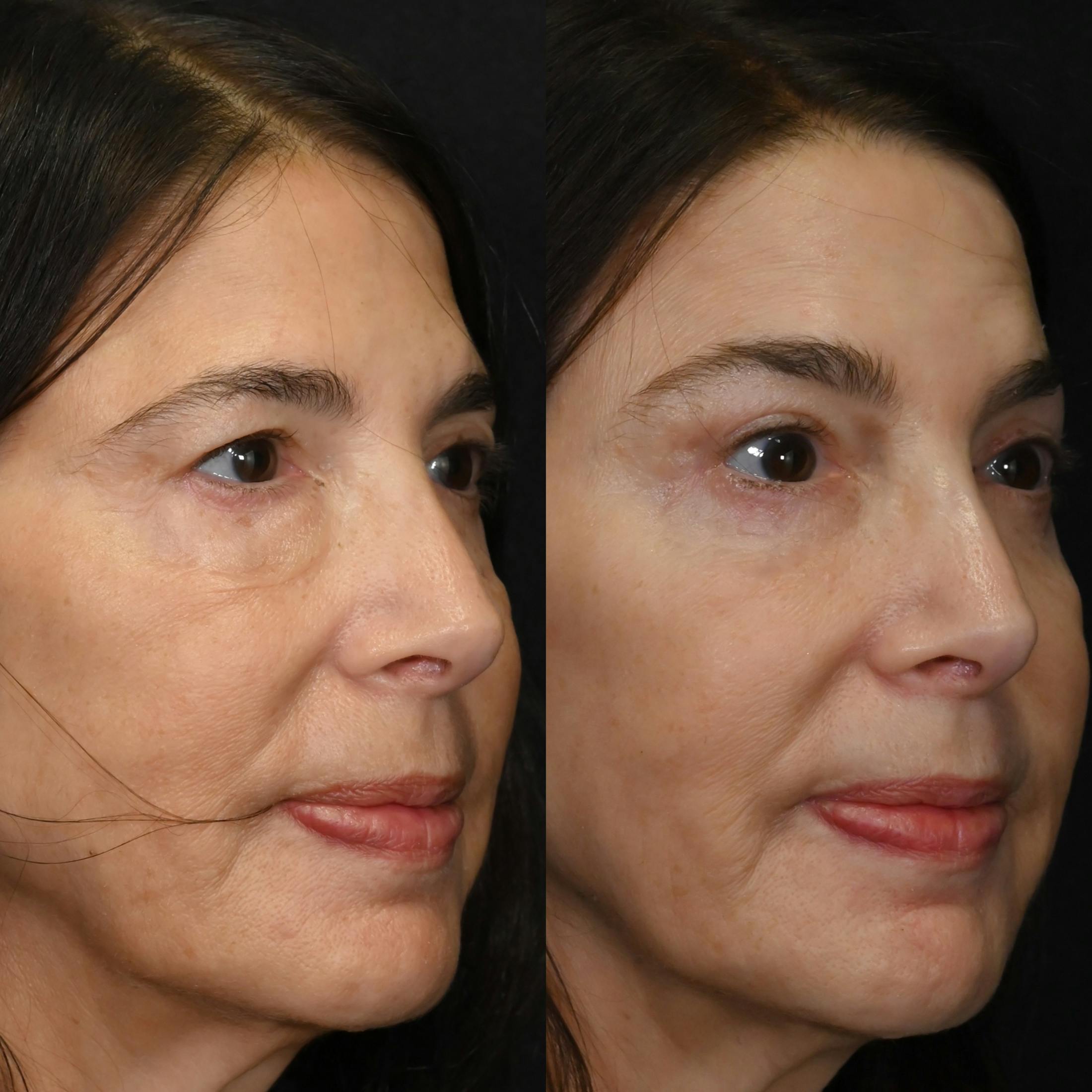 Upper & Lower Blepharoplasty Before & After Gallery - Patient 171889 - Image 2
