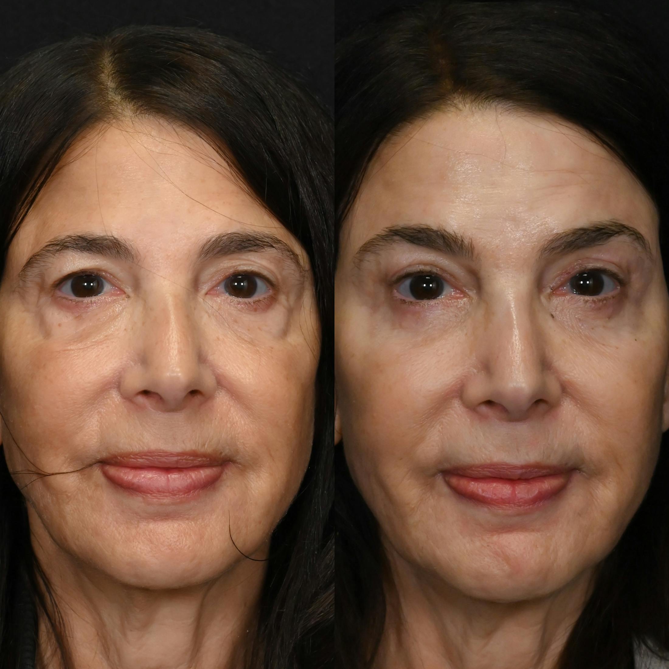 Upper & Lower Blepharoplasty Before & After Gallery - Patient 171889 - Image 1