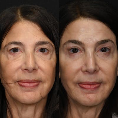 Upper Blepharoplasty Before & After Gallery - Patient 296939 - Image 1