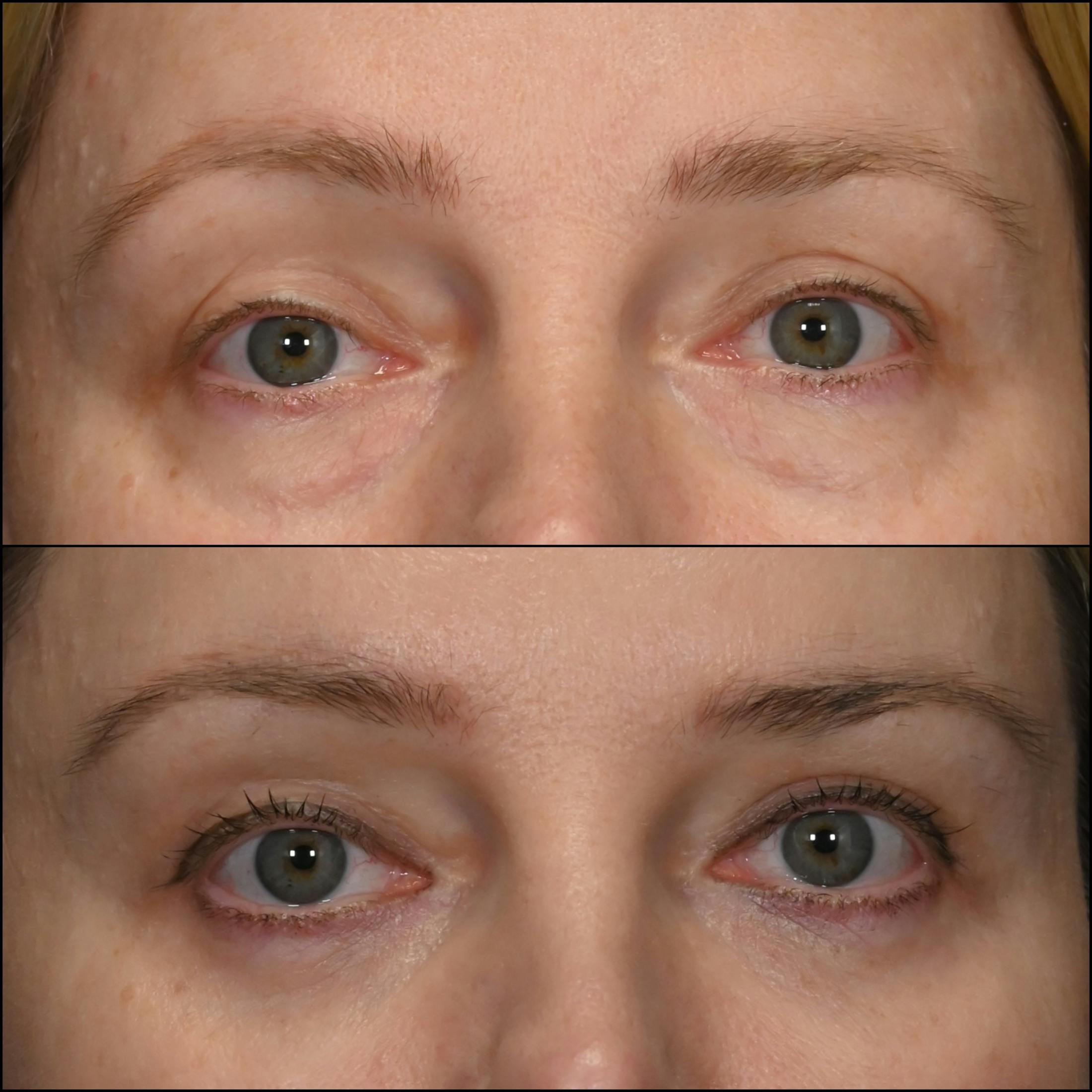 Lower Blepharoplasty Before & After Gallery - Patient 341072 - Image 1