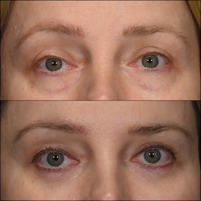 Lower Blepharoplasty Before & After Gallery - Patient 341072 - Image 1