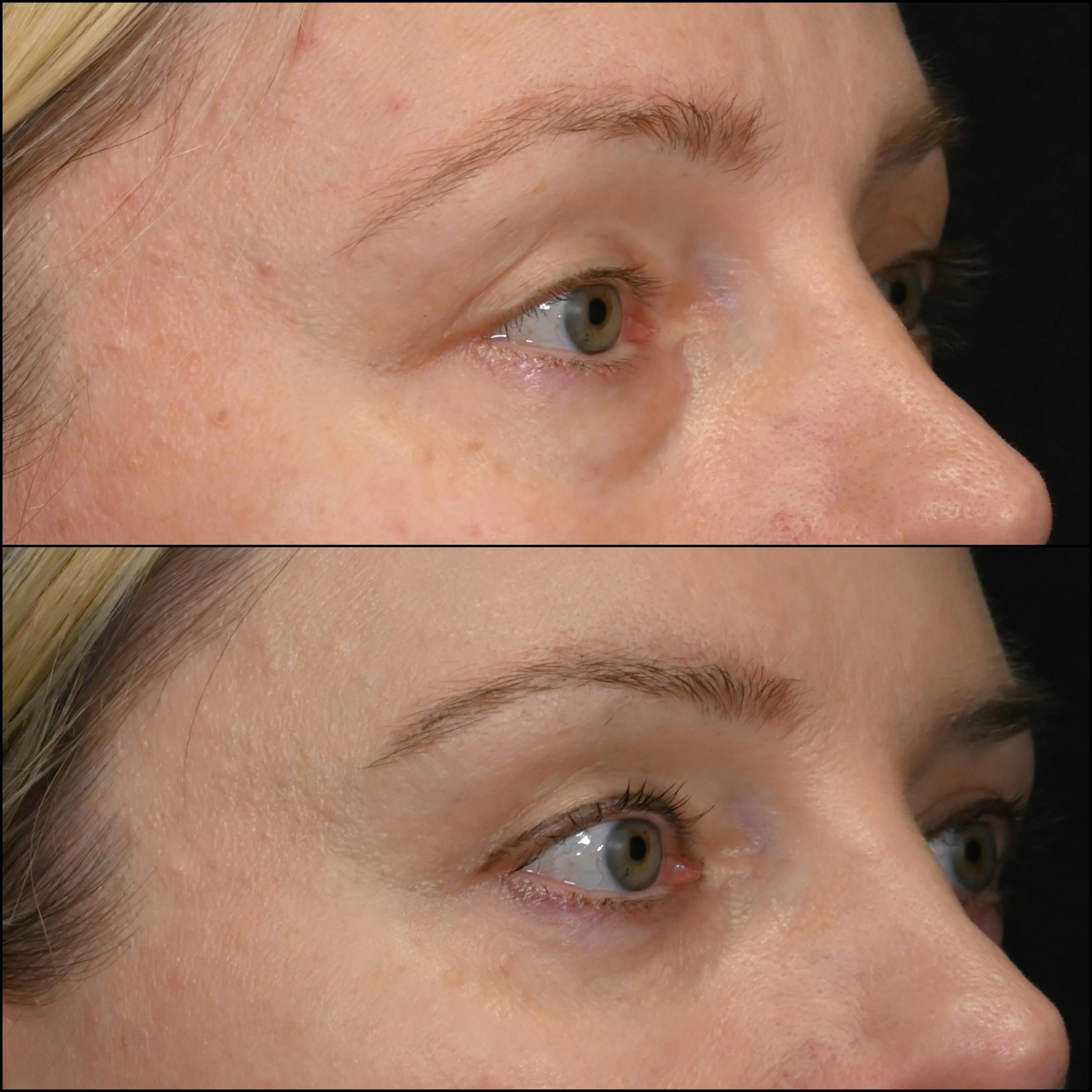 Lower Blepharoplasty Before & After Gallery - Patient 341072 - Image 2