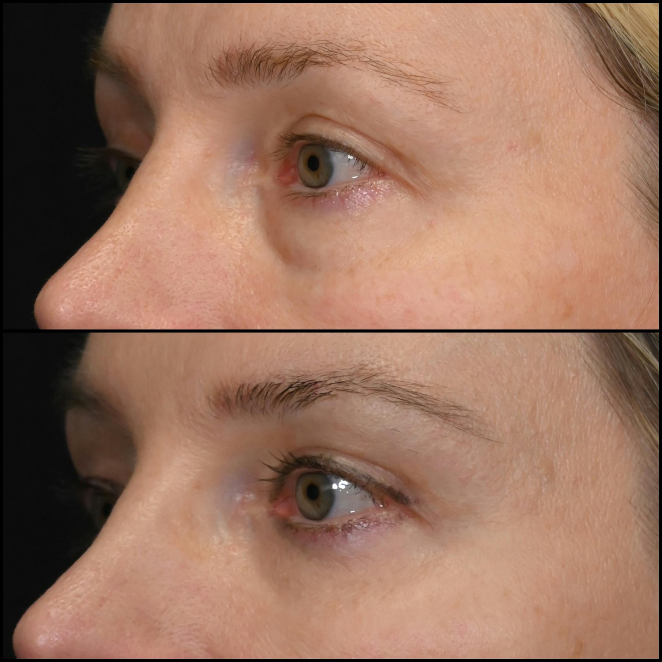 Lower Blepharoplasty Before & After Gallery - Patient 341072 - Image 3