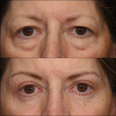 Upper Blepharoplasty Before & After Gallery - Patient 349352 - Image 1